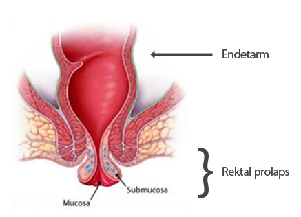 rektal prolaps