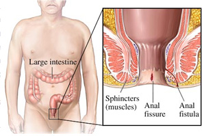 Anal fissure - Højsgaard - Consultant Surgeon and Gastroenterologist