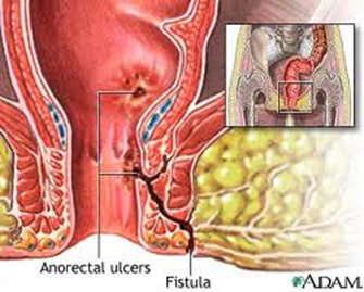 anal fistula