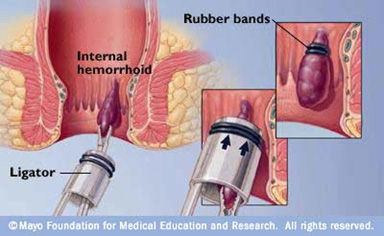 Beginner Kameraad Circulaire Rubber band ligation hemorrhoids - Højsgaard - Gastroenterologist