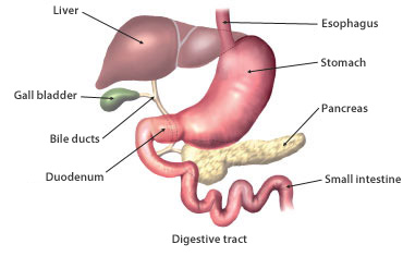 gallstones