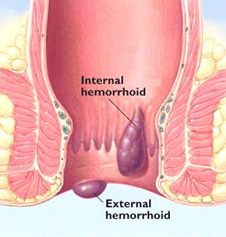 hæmorider