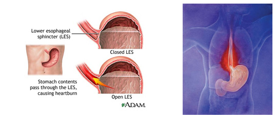 reflux 1